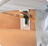 DAL 316 EA/1 FOLEY CATH HOLDER, LEGBAND 2IN X 19.5IN