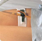 DAL 316 EA/1 FOLEY CATH HOLDER, LEGBAND 2IN X 19.5IN