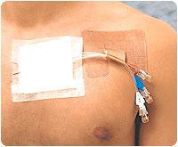 DUP CS50 BX/50 CATH STRIP RECLOSEABLE CATHETER FASTENER